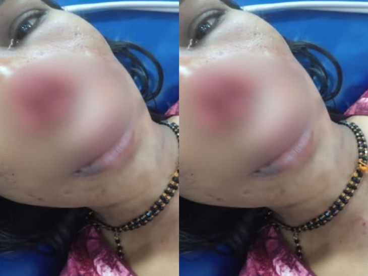 कर्नाटक में व्यक्ति ने पत्नी की नाक चबाई:  कर्ज चुकाने को लेकर लड़ाई हुई थी; यूपी में डिप्टी डायरेक्टर ने इंजीनियर की नाक काटी थी